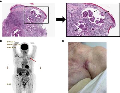 Cutaneous Breast Cancer Metastasis Is Effectively Treated With Intralesional Interleukin-2 and Imiquimod: A Case Report and Brief Literature Review